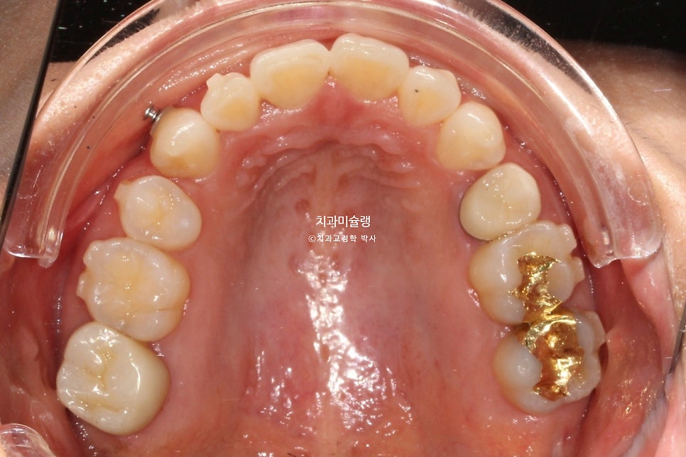 30대 긴 인중과 얇은 입술, 덧니 발치 교정 인비절라인 치료기간 2년 4개월 재제작 1회