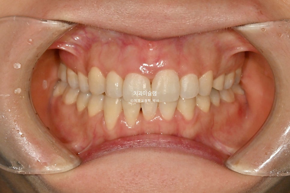 30대 긴 인중과 얇은 입술, 덧니 발치 교정 인비절라인 치료기간 2년 4개월 재제작 1회