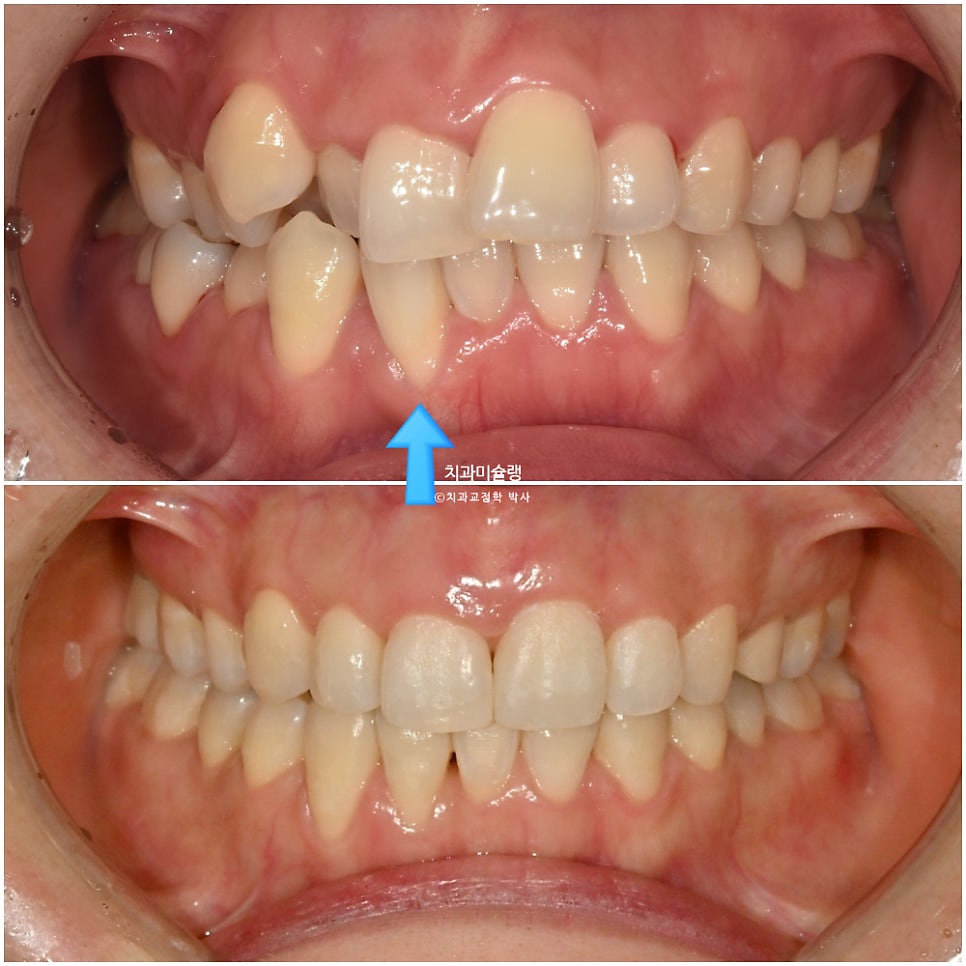 30대 긴 인중과 얇은 입술, 덧니 발치 교정 인비절라인 치료기간 2년 4개월 재제작 1회