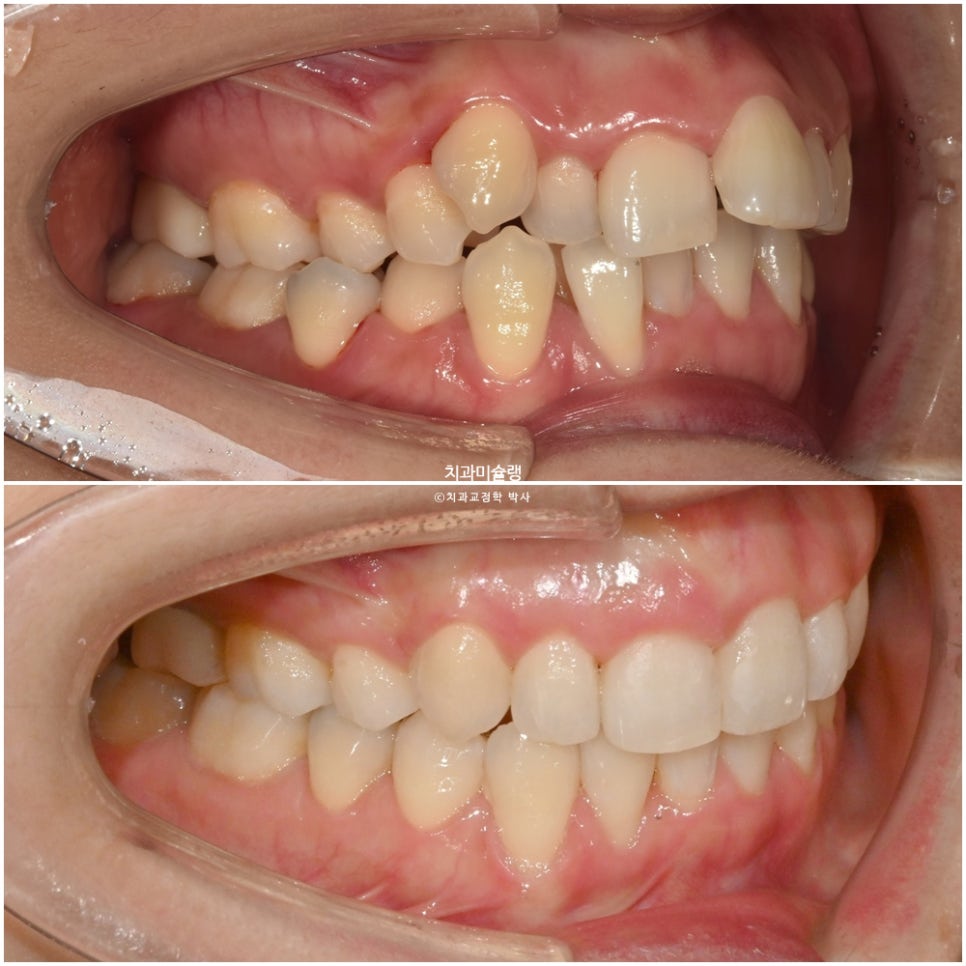30대 긴 인중과 얇은 입술, 덧니 발치 교정 인비절라인 치료기간 2년 4개월 재제작 1회