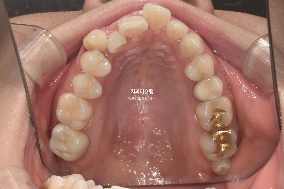 30대 긴 인중과 얇은 입술, 덧니 발치 교정 인비절라인 치료기간 2년 4개월 재제작 1회