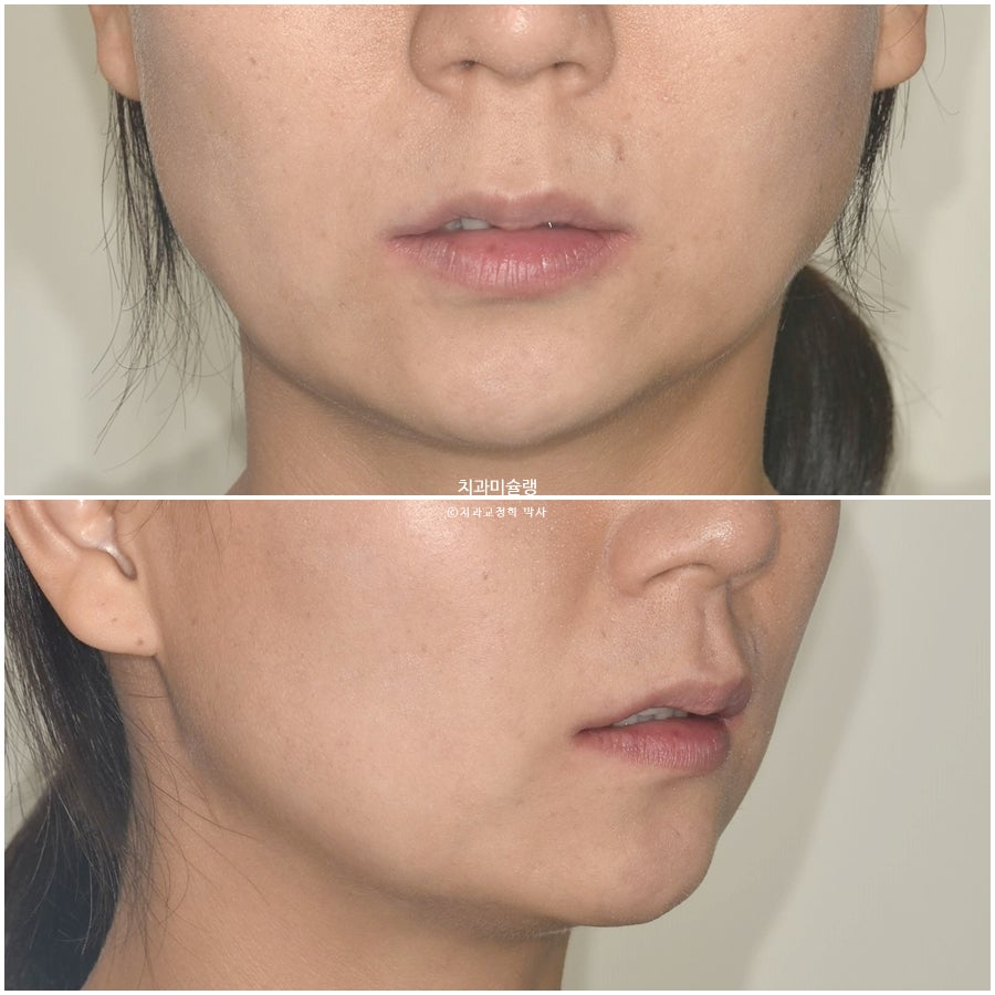 30대 긴 인중과 얇은 입술, 덧니 발치 교정 인비절라인 치료기간 2년 4개월 재제작 1회