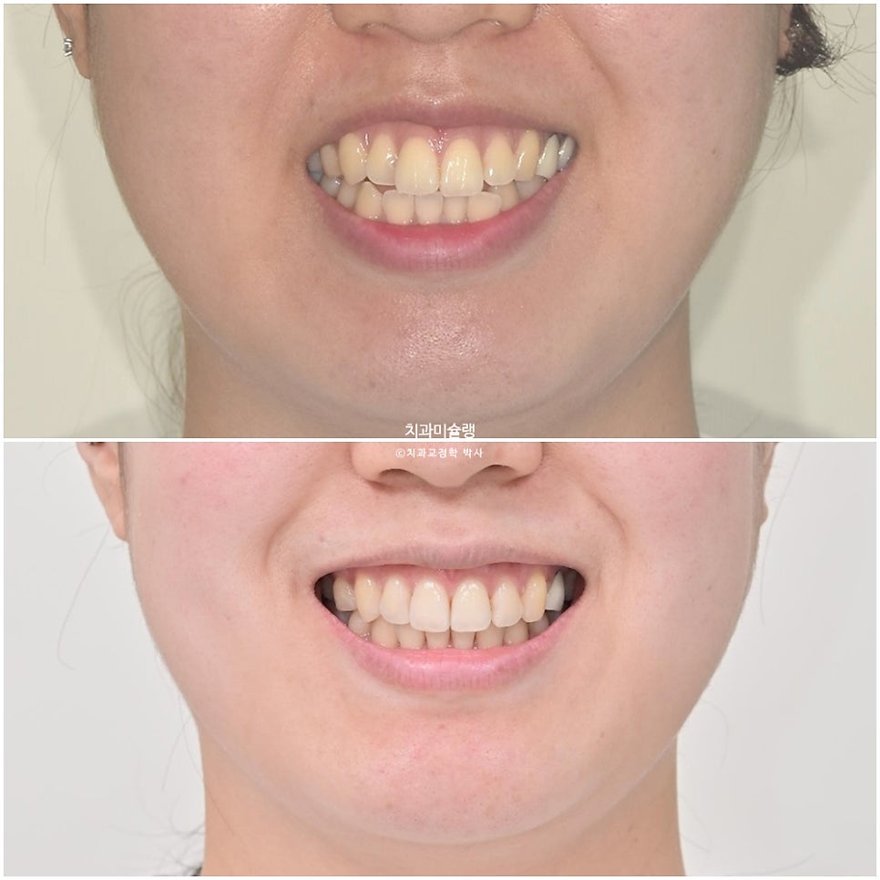 돌출입 발치교정 개방교합 무턱 재교정 인비절라인 입술부전증 치료기간 2년8개월 재제작 2회