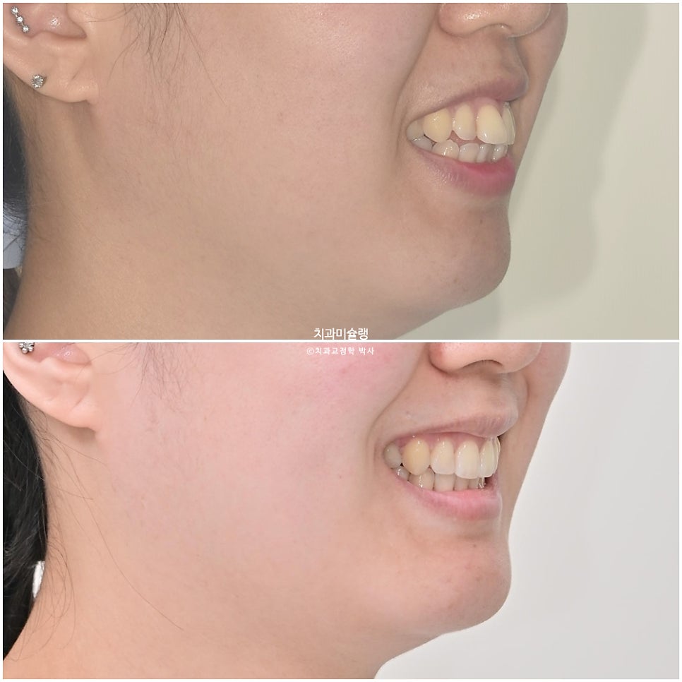 돌출입 발치교정 개방교합 무턱 재교정 인비절라인 입술부전증 치료기간 2년8개월 재제작 2회