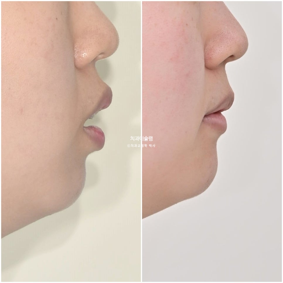 돌출입 발치교정 개방교합 무턱 재교정 인비절라인 입술부전증 치료기간 2년8개월 재제작 2회