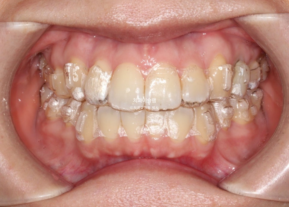 돌출입 발치교정 개방교합 무턱 재교정 인비절라인 입술부전증 치료기간 2년8개월 재제작 2회