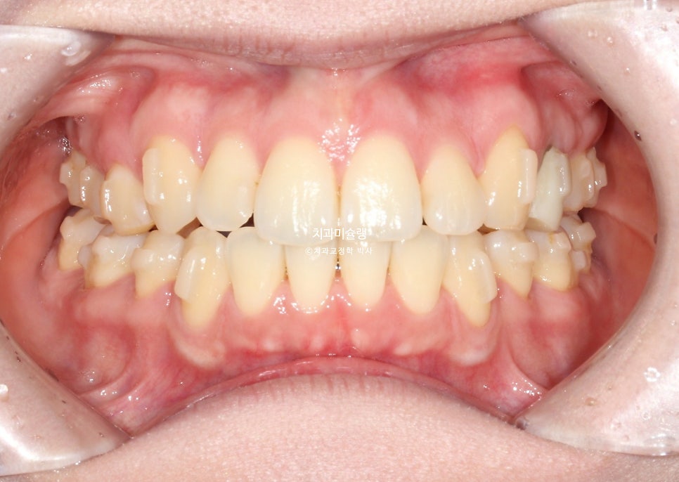 돌출입 발치교정 개방교합 무턱 재교정 인비절라인 입술부전증 치료기간 2년8개월 재제작 2회