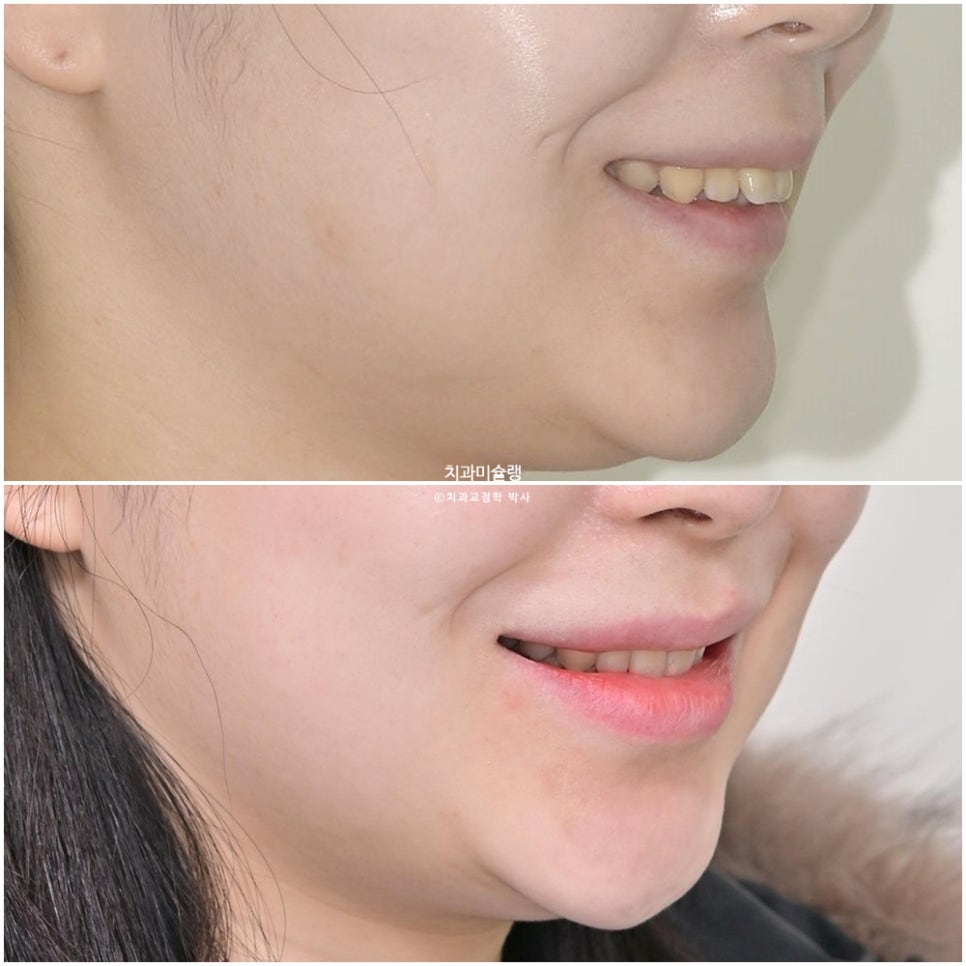 인비절라인 상악 돌출 편악 발치 교정 미니스크류 외상치 사랑니 미니스크류 재제작 3회 치료기간 2년 8개월