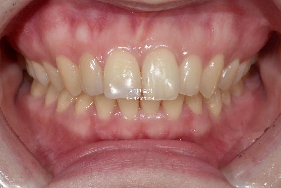 인비절라인 상악 돌출 편악 발치 교정 미니스크류 외상치 사랑니 미니스크류 재제작 3회 치료기간 2년 8개월