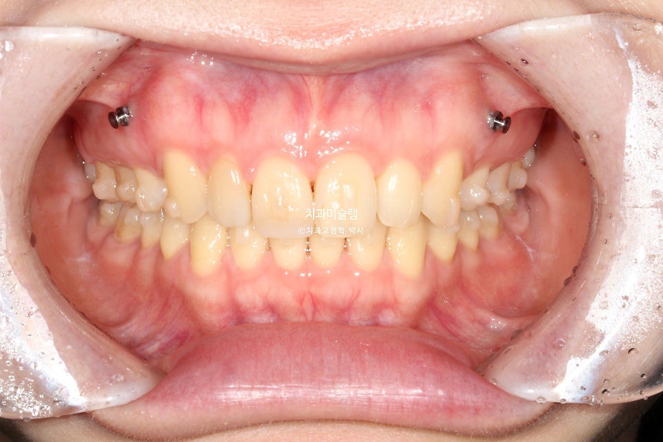 인비절라인 상악 돌출 편악 발치 교정 미니스크류 외상치 사랑니 미니스크류 재제작 3회 치료기간 2년 8개월
