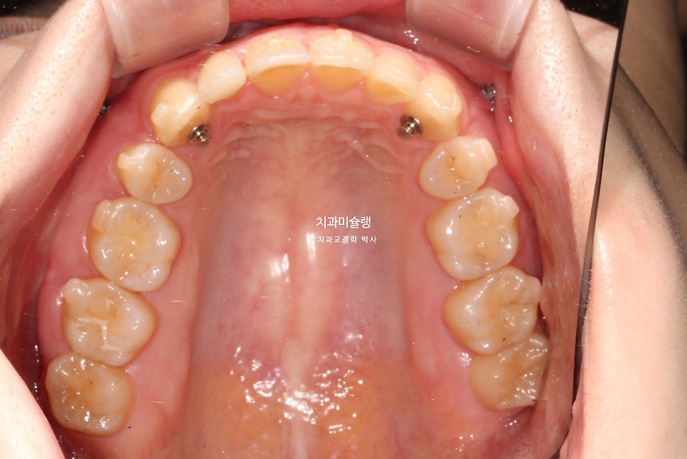 인비절라인 상악 돌출 편악 발치 교정 미니스크류 외상치 사랑니 미니스크류 재제작 3회 치료기간 2년 8개월