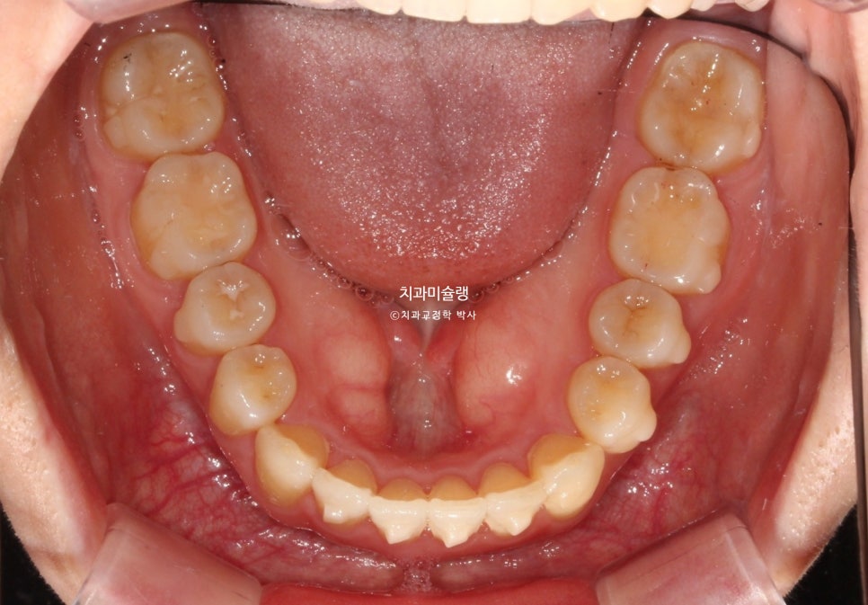 인비절라인 상악 돌출 편악 발치 교정 미니스크류 외상치 사랑니 미니스크류 재제작 3회 치료기간 2년 8개월