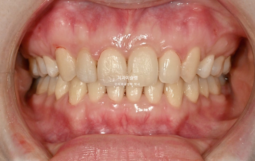 인비절라인 상악 돌출 편악 발치 교정 미니스크류 외상치 사랑니 미니스크류 재제작 3회 치료기간 2년 8개월