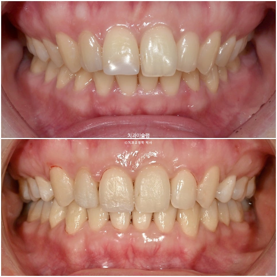 인비절라인 상악 돌출 편악 발치 교정 미니스크류 외상치 사랑니 미니스크류 재제작 3회 치료기간 2년 8개월