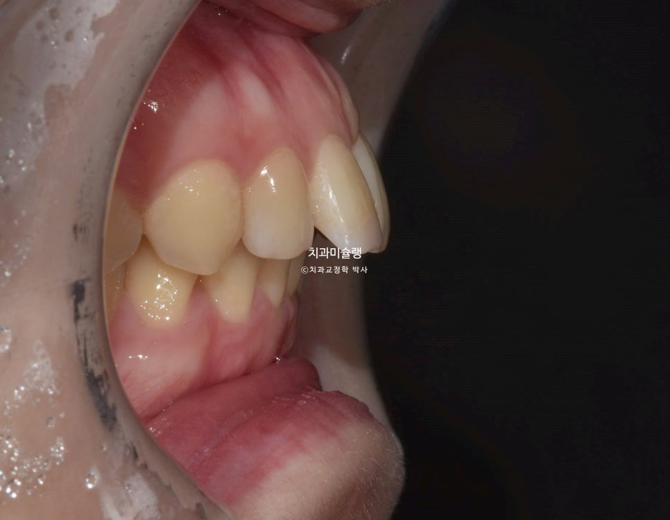 인비절라인 상악 돌출 편악 발치 교정 미니스크류 외상치 사랑니 미니스크류 재제작 3회 치료기간 2년 8개월