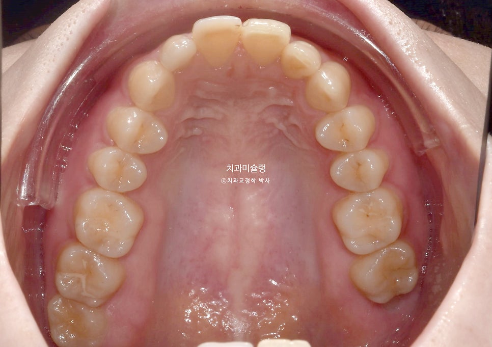 인비절라인 상악 돌출 편악 발치 교정 미니스크류 외상치 사랑니 미니스크류 재제작 3회 치료기간 2년 8개월