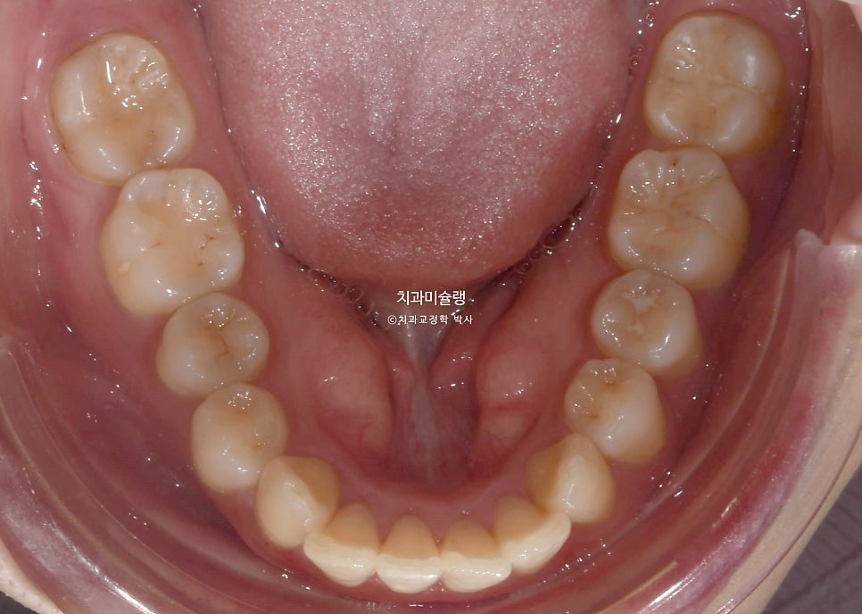 인비절라인 상악 돌출 편악 발치 교정 미니스크류 외상치 사랑니 미니스크류 재제작 3회 치료기간 2년 8개월