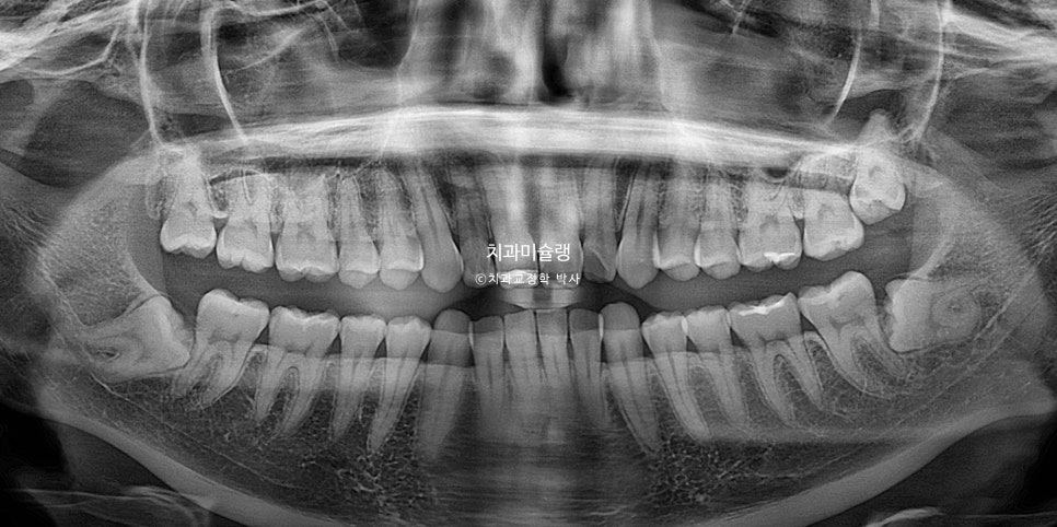인비절라인 상악 돌출 편악 발치 교정 미니스크류 외상치 사랑니 미니스크류 재제작 3회 치료기간 2년 8개월