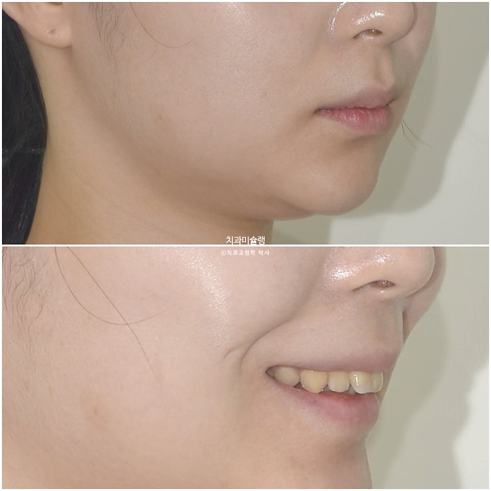 인비절라인 상악 돌출 편악 발치 교정 미니스크류 외상치 사랑니 미니스크류 재제작 3회 치료기간 2년 8개월