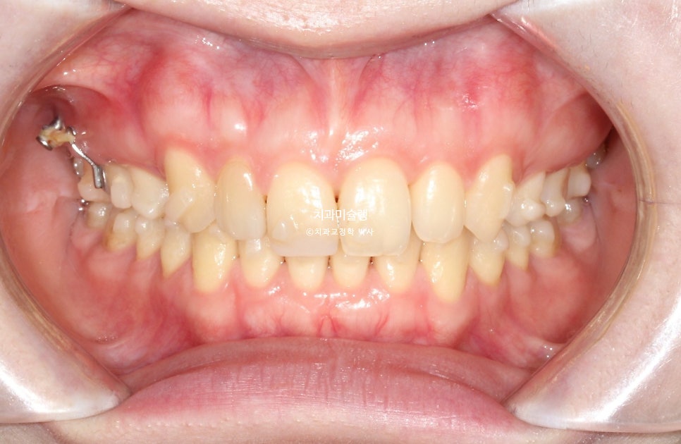 인비절라인 상악 돌출 편악 발치 교정 미니스크류 외상치 사랑니 미니스크류 재제작 3회 치료기간 2년 8개월