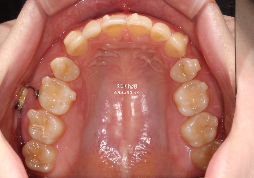 인비절라인 상악 돌출 편악 발치 교정 미니스크류 외상치 사랑니 미니스크류 재제작 3회 치료기간 2년 8개월
