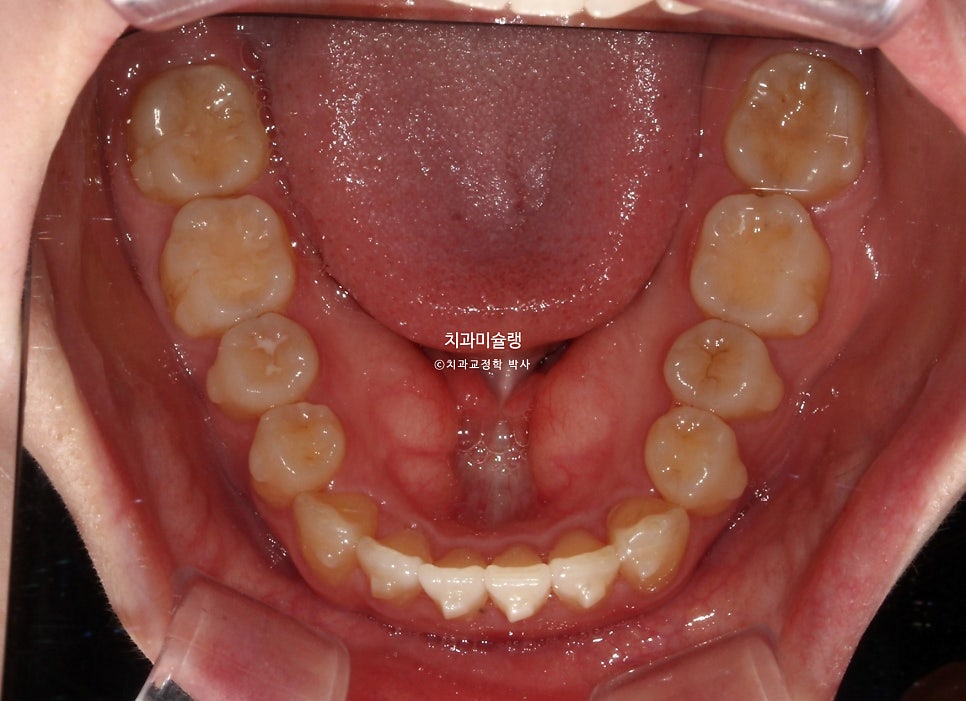 인비절라인 상악 돌출 편악 발치 교정 미니스크류 외상치 사랑니 미니스크류 재제작 3회 치료기간 2년 8개월