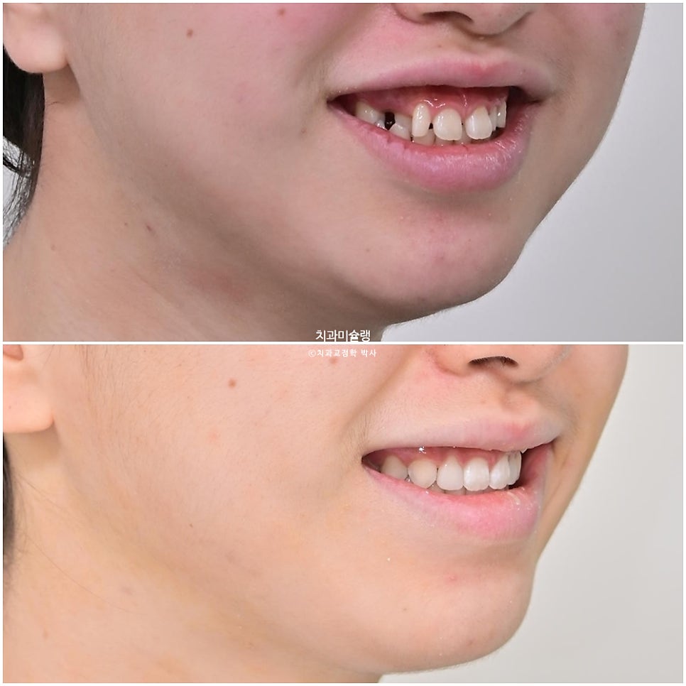 인비절라인 벌어짐 이소맹출 왜소치 덧니 과개교합 반대교합 돌출 중심선 비발치 교정 치료기간 1년 재제작 1회