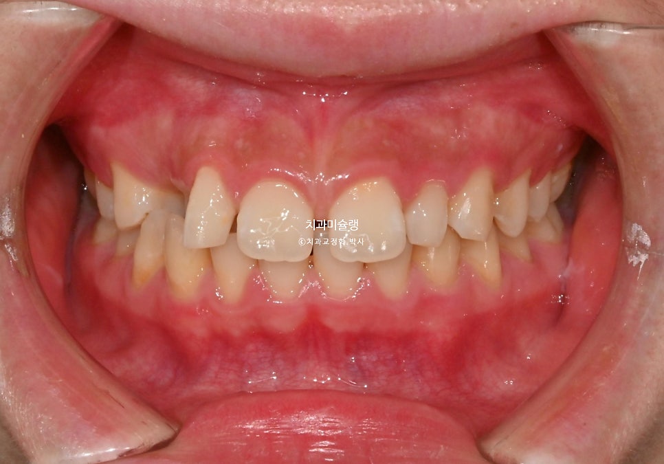 인비절라인 벌어짐 이소맹출 왜소치 덧니 과개교합 반대교합 돌출 중심선 비발치 교정 치료기간 1년 재제작 1회