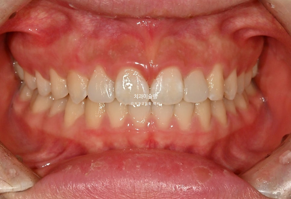 인비절라인 벌어짐 이소맹출 왜소치 덧니 과개교합 반대교합 돌출 중심선 비발치 교정 치료기간 1년 재제작 1회