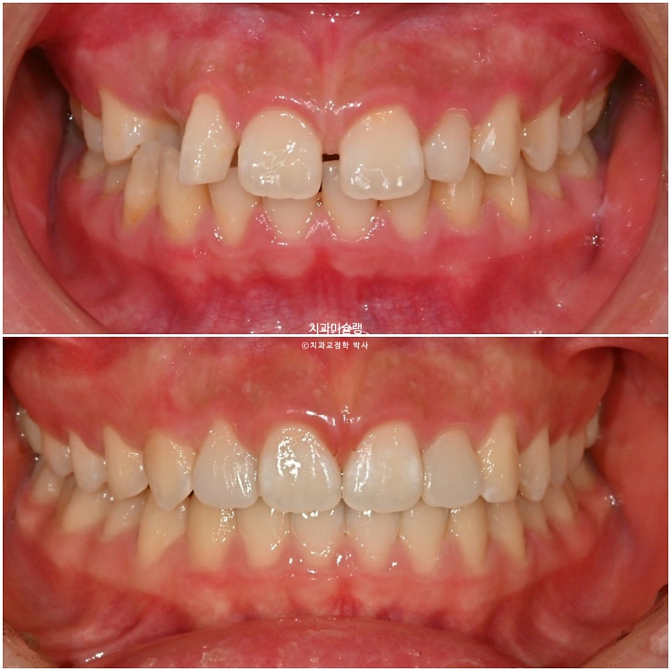 인비절라인 벌어짐 이소맹출 왜소치 덧니 과개교합 반대교합 돌출 중심선 비발치 교정 치료기간 1년 재제작 1회