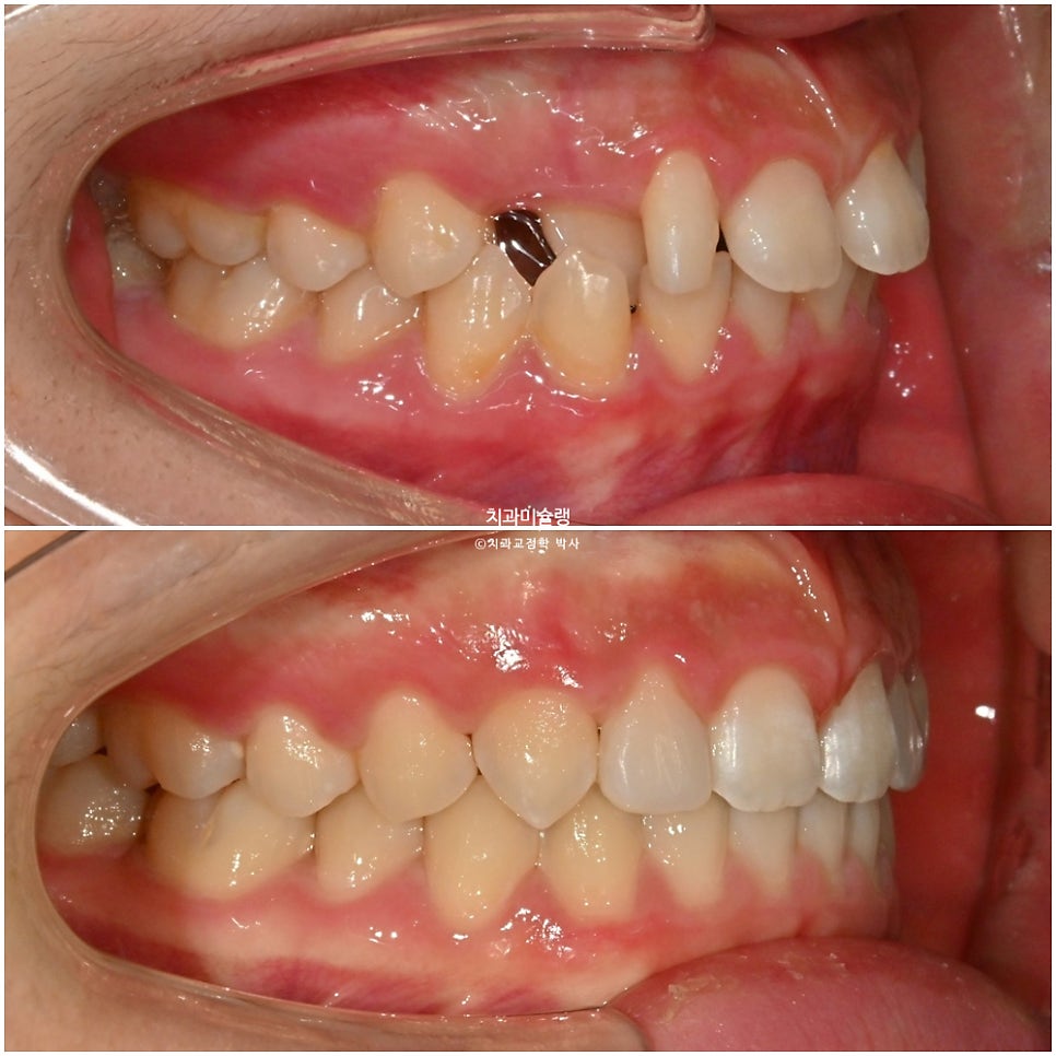인비절라인 벌어짐 이소맹출 왜소치 덧니 과개교합 반대교합 돌출 중심선 비발치 교정 치료기간 1년 재제작 1회