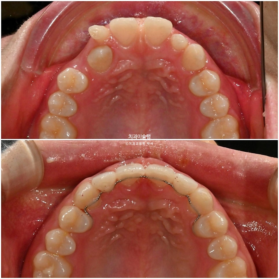 인비절라인 벌어짐 이소맹출 왜소치 덧니 과개교합 반대교합 돌출 중심선 비발치 교정 치료기간 1년 재제작 1회
