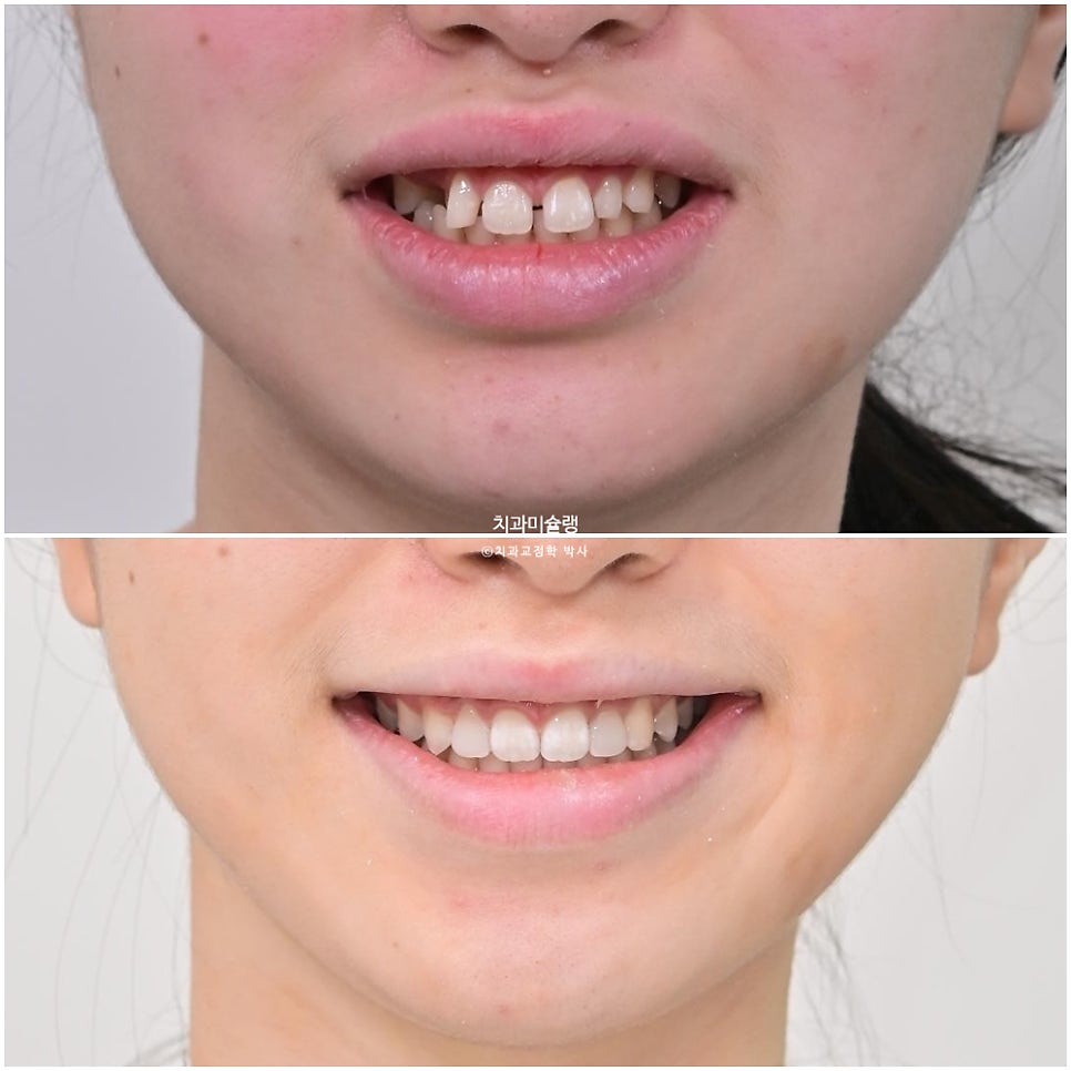 인비절라인 벌어짐 이소맹출 왜소치 덧니 과개교합 반대교합 돌출 중심선 비발치 교정 치료기간 1년 재제작 1회