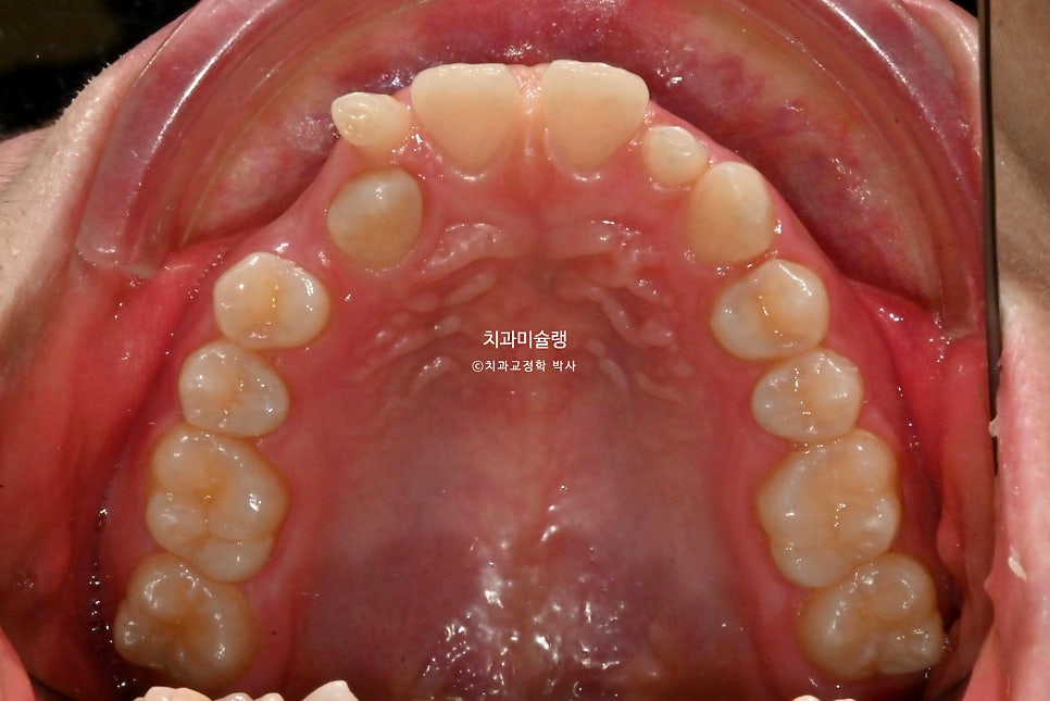 인비절라인 벌어짐 이소맹출 왜소치 덧니 과개교합 반대교합 돌출 중심선 비발치 교정 치료기간 1년 재제작 1회
