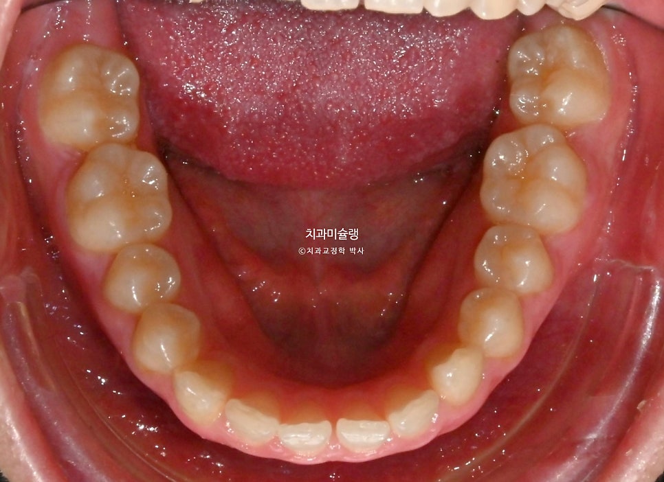 인비절라인 벌어짐 이소맹출 왜소치 덧니 과개교합 반대교합 돌출 중심선 비발치 교정 치료기간 1년 재제작 1회
