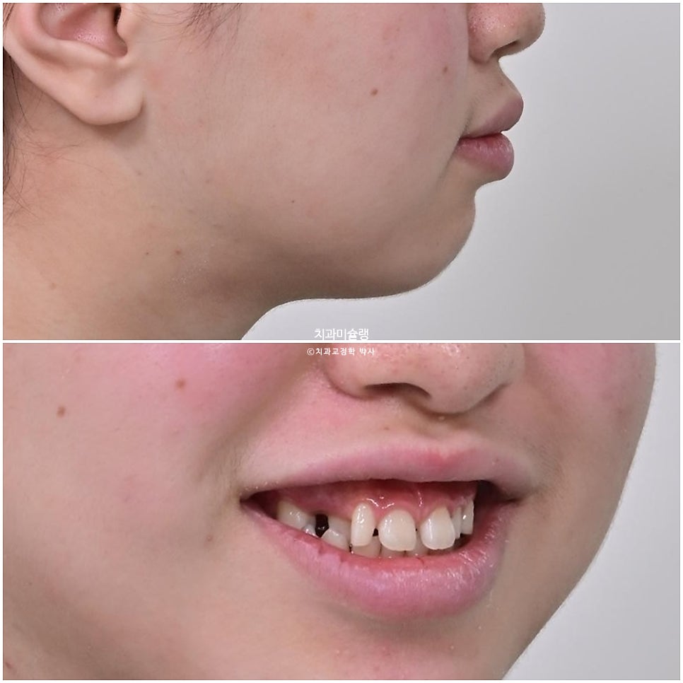 인비절라인 벌어짐 이소맹출 왜소치 덧니 과개교합 반대교합 돌출 중심선 비발치 교정 치료기간 1년 재제작 1회