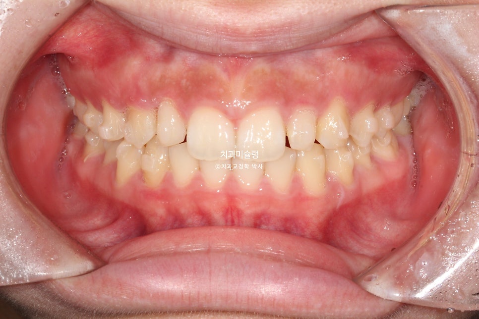 인비절라인 벌어짐 이소맹출 왜소치 덧니 과개교합 반대교합 돌출 중심선 비발치 교정 치료기간 1년 재제작 1회