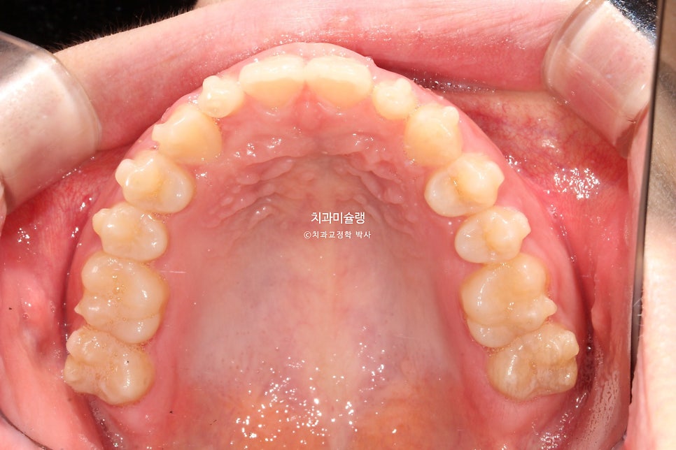 인비절라인 벌어짐 이소맹출 왜소치 덧니 과개교합 반대교합 돌출 중심선 비발치 교정 치료기간 1년 재제작 1회