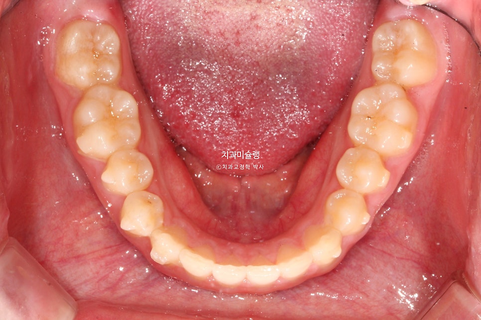 인비절라인 벌어짐 이소맹출 왜소치 덧니 과개교합 반대교합 돌출 중심선 비발치 교정 치료기간 1년 재제작 1회