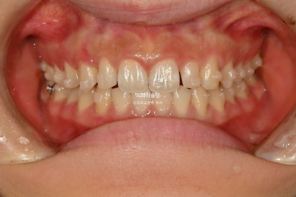 인비절라인 벌어짐 이소맹출 왜소치 덧니 과개교합 반대교합 돌출 중심선 비발치 교정 치료기간 1년 재제작 1회