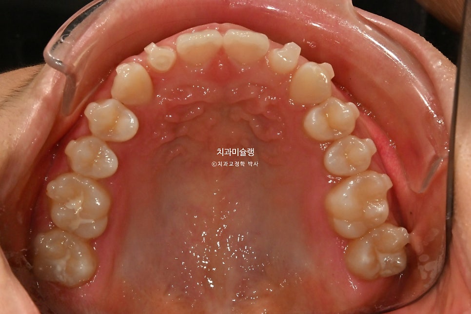 인비절라인 벌어짐 이소맹출 왜소치 덧니 과개교합 반대교합 돌출 중심선 비발치 교정 치료기간 1년 재제작 1회