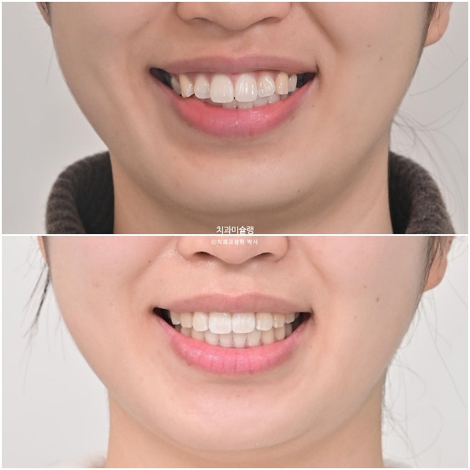돌출 덧니 반대교합 비발치 인비절라인 라이트 치료기간 10개월 재제작 1회 어금니 교합 뜰때 치료방법
