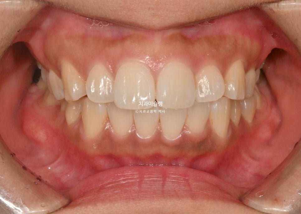 돌출 덧니 반대교합 비발치 인비절라인 라이트 치료기간 10개월 재제작 1회 어금니 교합 뜰때 치료방법