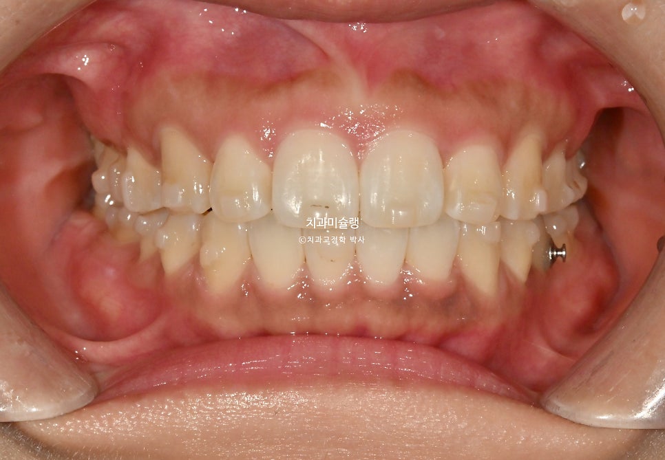 돌출 덧니 반대교합 비발치 인비절라인 라이트 치료기간 10개월 재제작 1회 어금니 교합 뜰때 치료방법