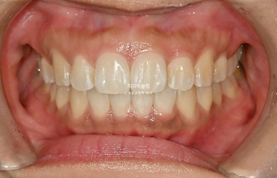 돌출 덧니 반대교합 비발치 인비절라인 라이트 치료기간 10개월 재제작 1회 어금니 교합 뜰때 치료방법