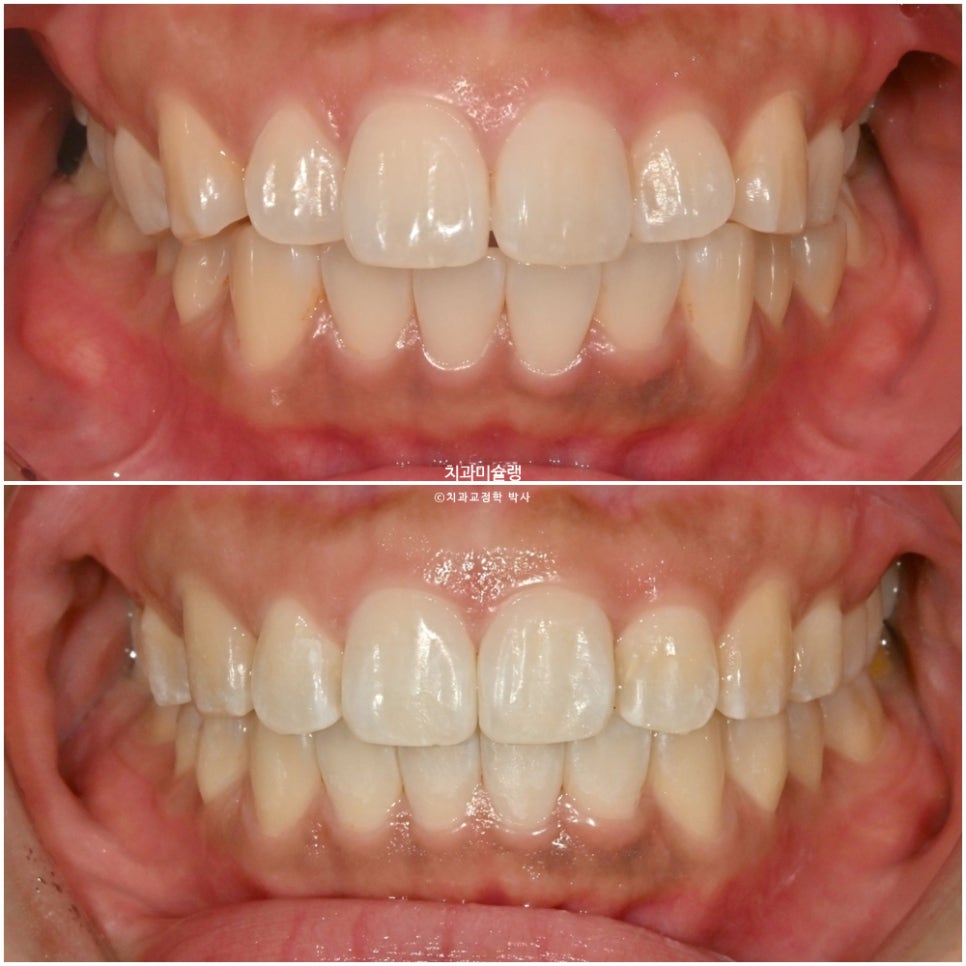돌출 덧니 반대교합 비발치 인비절라인 라이트 치료기간 10개월 재제작 1회 어금니 교합 뜰때 치료방법