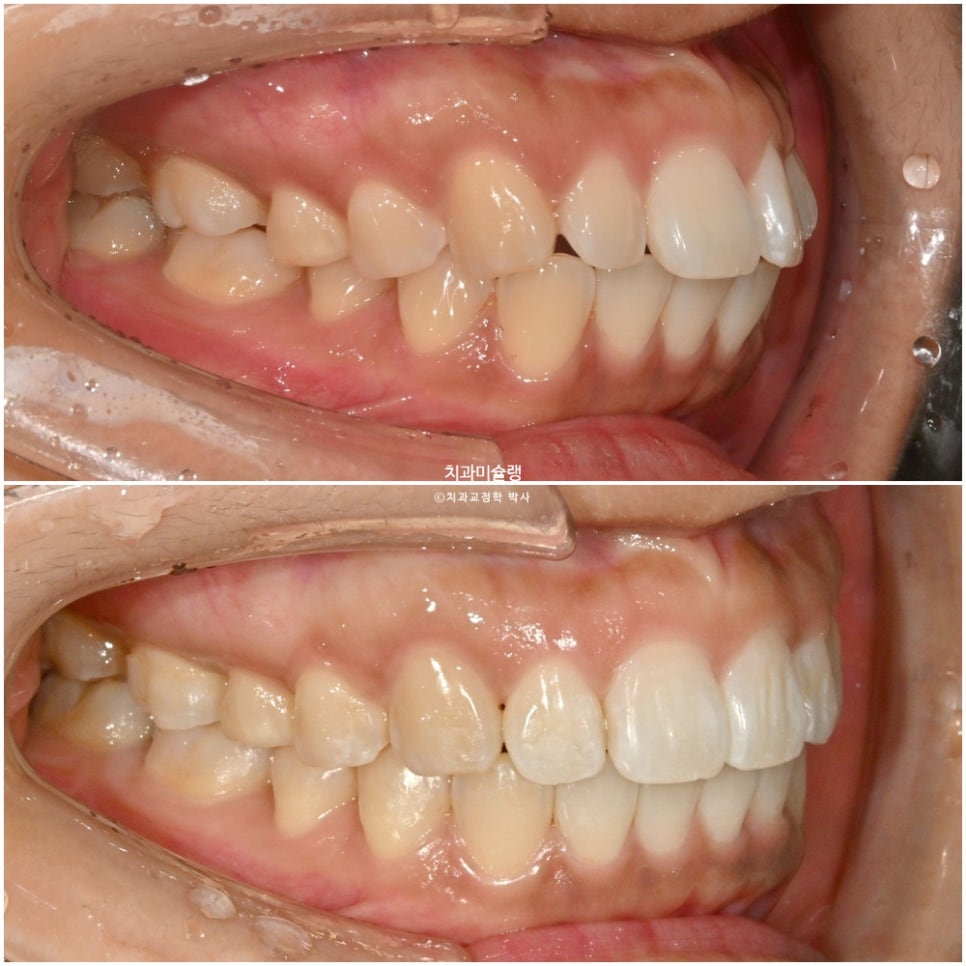 돌출 덧니 반대교합 비발치 인비절라인 라이트 치료기간 10개월 재제작 1회 어금니 교합 뜰때 치료방법
