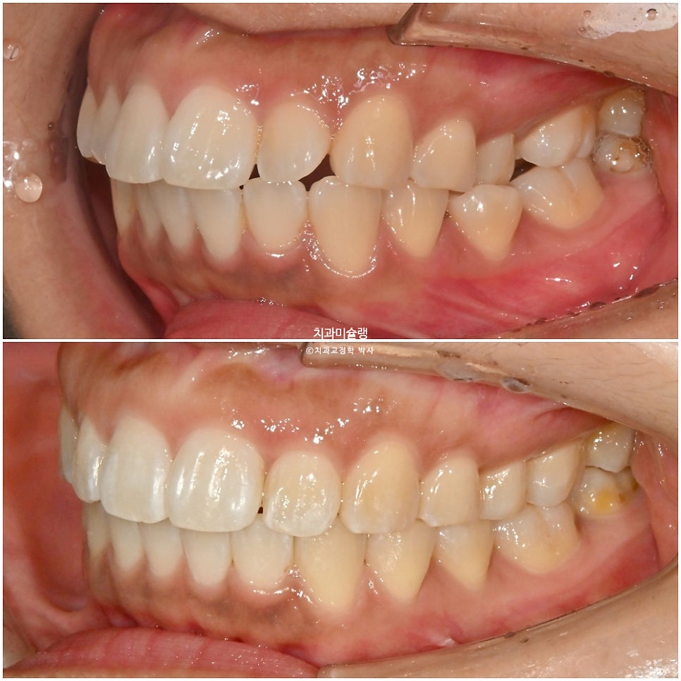 돌출 덧니 반대교합 비발치 인비절라인 라이트 치료기간 10개월 재제작 1회 어금니 교합 뜰때 치료방법