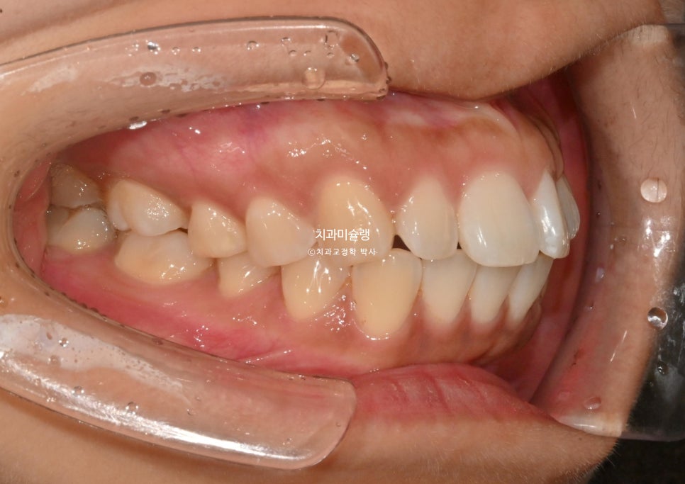 돌출 덧니 반대교합 비발치 인비절라인 라이트 치료기간 10개월 재제작 1회 어금니 교합 뜰때 치료방법
