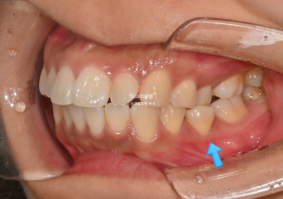 돌출 덧니 반대교합 비발치 인비절라인 라이트 치료기간 10개월 재제작 1회 어금니 교합 뜰때 치료방법